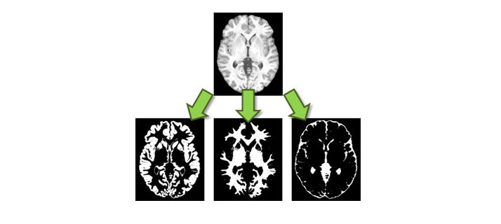 Detection of impaired brain through magnetic resonance imaging